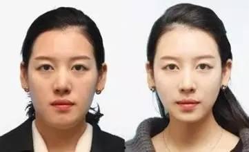 国产瘦脸针案例视频